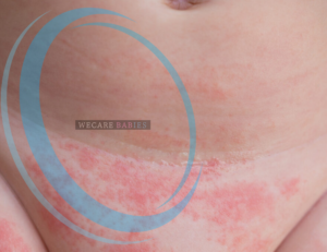 Is diaper rash common in newborn babies